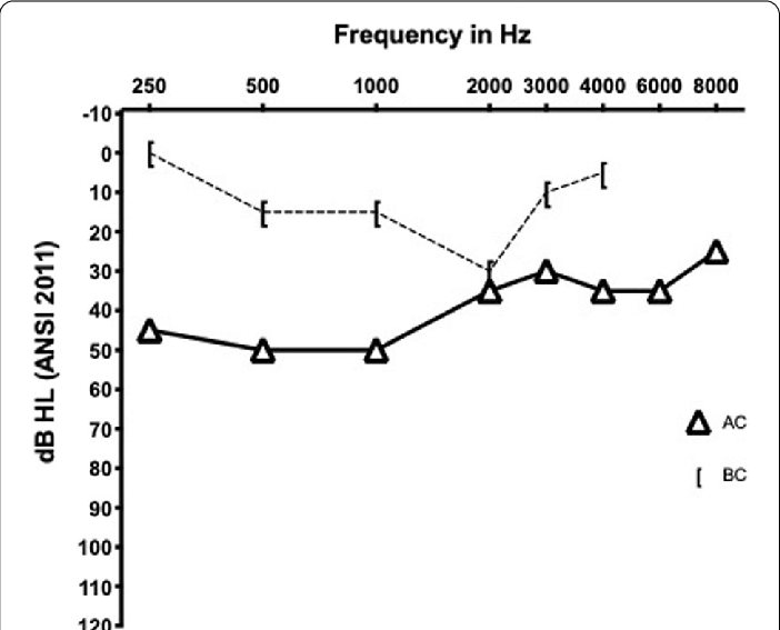 Audiogramme tonal montrant une encoche de Carhart à 2 000 Hz